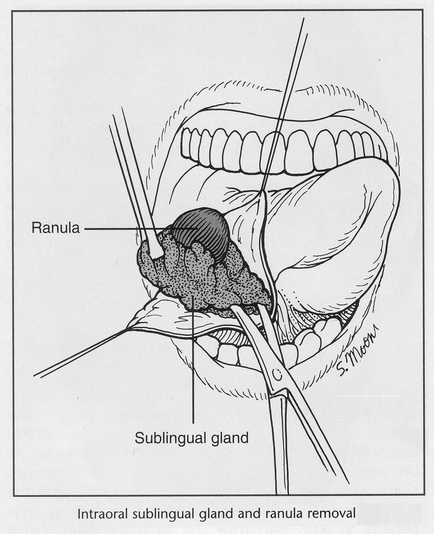 Sublingual Gland Removal5